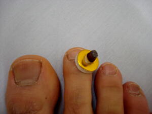 井穴（F6)にせんねん灸