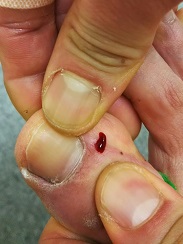 F2から刺絡のやり方