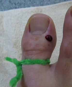 井穴刺絡療法　1回の血の量