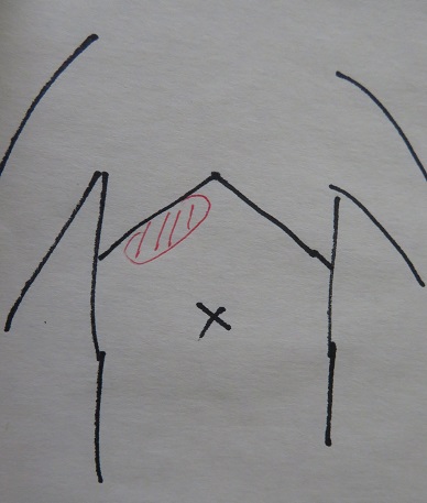 腹診　右季肋部に圧痛