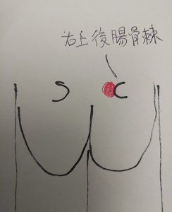 右上後腸骨棘の痛み図