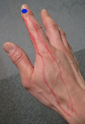 大腸経の経筋治療ポイント