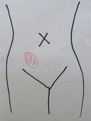 虫垂炎の反応　右下腹部の圧痛