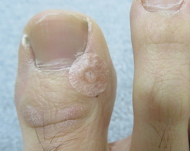 井穴にパイオネックス貼付後シールを外す画像