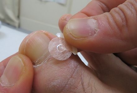 井穴にパイオネックス