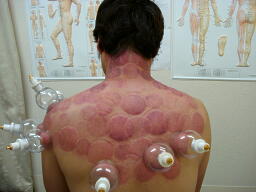 首・肩・背中に対する吸玉療法の様子の画像