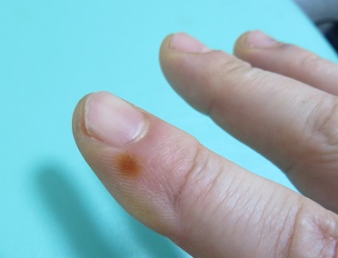 井穴に八分（はちぶ）灸した後の画像