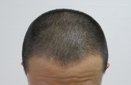 電動バリカンPanasonic ER 5204Pの6ミリのアタッチメントによるカット画像