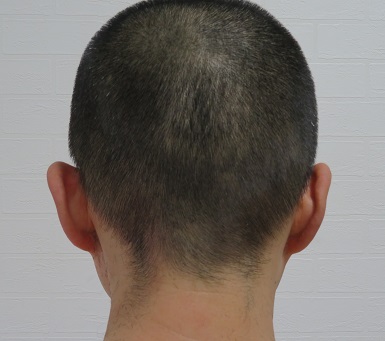 電動バリカンPanasonic ER 5204Pの6ミリのアタッチメントによるカット画像