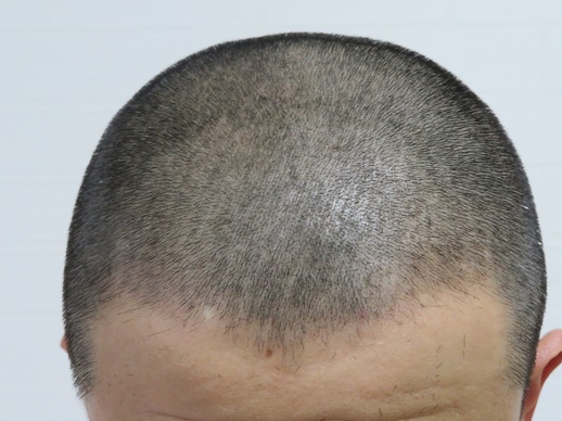 電動バリカンPanasonic ER 5204Pの3ミリのアタッチメントによるカット画像