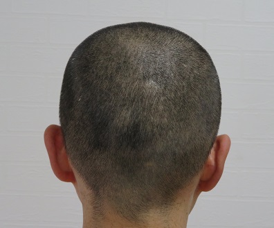 電動バリカンPanasonic ER 5204Pの3ミリのアタッチメントによるカット画像