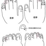 アトピーにH5F5井穴刺絡