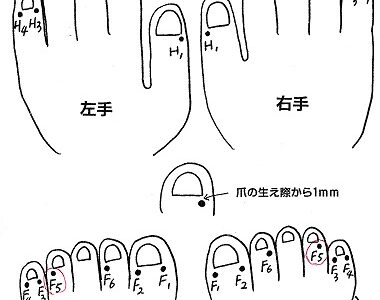 アトピーにH5F5井穴刺絡
