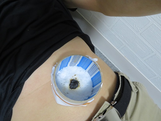 アトピーに対するへその灸の画像